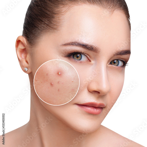 Young woman with zoom circle before and after acne treatment.