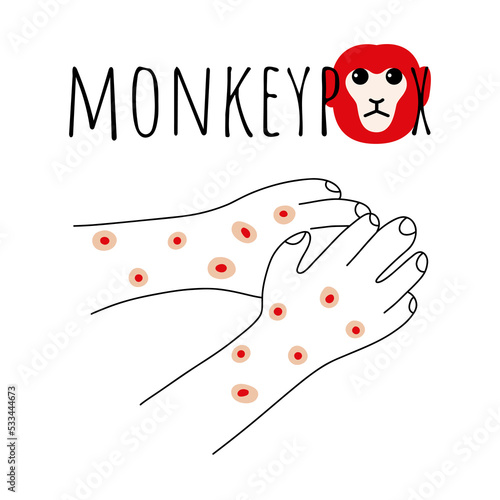 Monkeypox virus symptom doodle concept. Monkey face and hands with rash. Monkey pox script. Viral smallpox disease. Vector illustration.