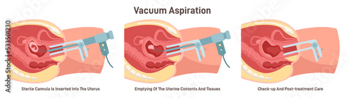 Vacuum aspiration set. Embryo or fetus vacuum removing. First trimester