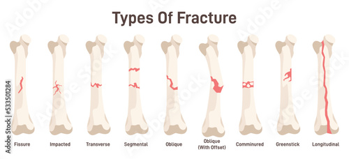 Types of bone fractures. Body injury, partial or complete break