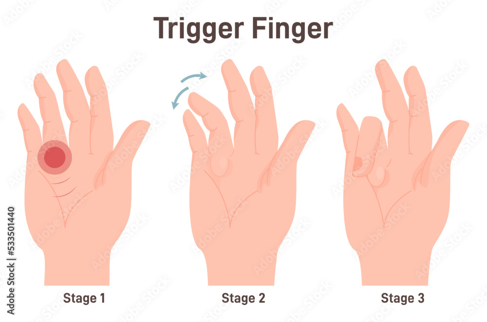 Trigger finger or finger lock. Disease causing pain, stiffness, and a sensation - obrazy, fototapety, plakaty 