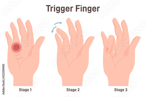 Fototapeta Naklejka Na Ścianę i Meble -  Trigger finger or finger lock. Disease causing pain, stiffness, and a sensation
