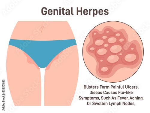 Genital herpes. Sexually transmitted infection, causing herpetic sores