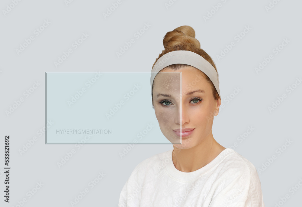 Crème Herbal Chloasma Care - Anti-imperfections, Hyperpigmentation, 30g, Herbes, Origine Inde