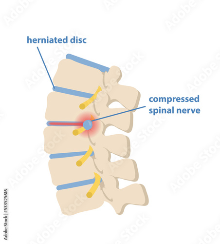 Sciatic nerve pinching concept. Pain in lumbar spine between vertebrae. Hernia of spinal cord. Design element for anatomy or education books. Cartoon flat vector illustration on white background