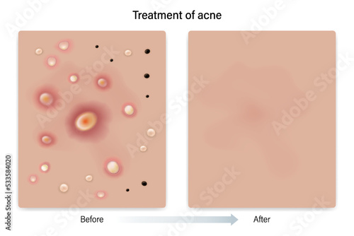 Treatment of acne. Skin before and after treatment. Blackheads, Whiteheads, Papules, Pustules, Nodules and Cysts. Vector for advertising about beauty and medical treatment.