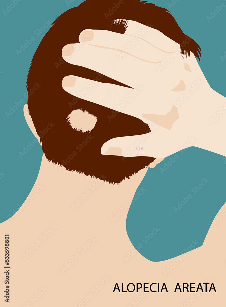 Back view of man alopecia areata bald spot, illustration on green background Back view of man alopecia areata bald spot, illustration on green background