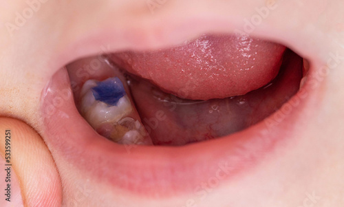 Colored blue filling in a child's tooth after caries treatment. Modern medicine with colorful fillings for children.