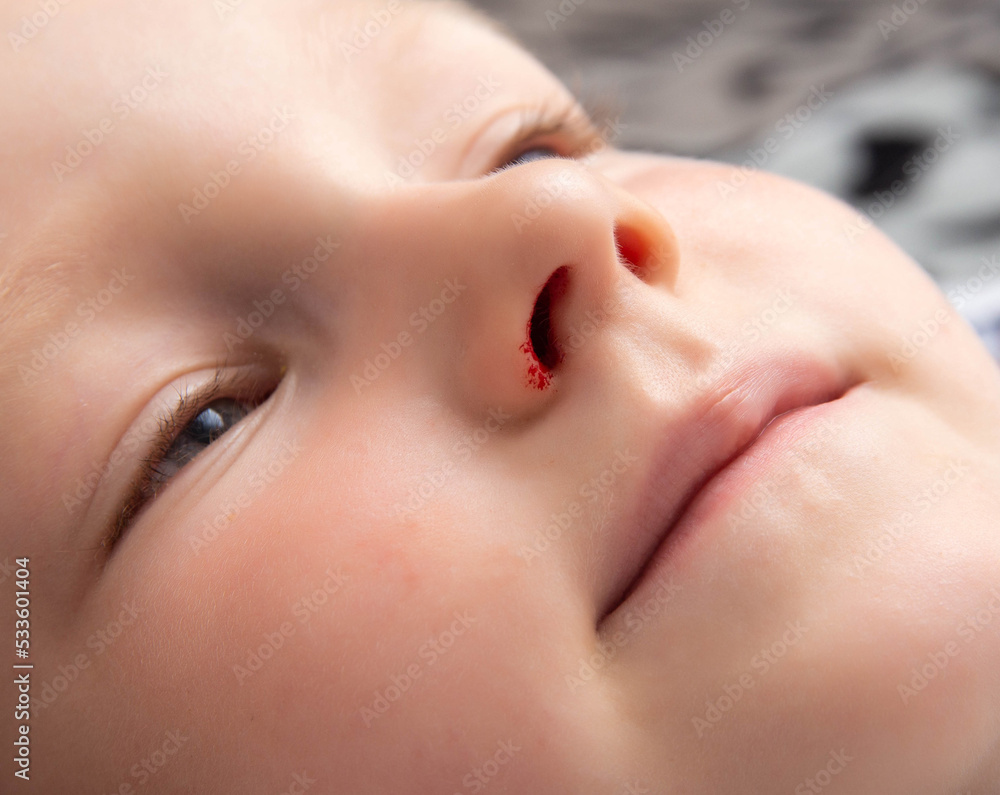 The face of a little caucasian girl with a nosebleed. Nosebleeds in children as a symptom, trauma. The face of a little caucasian girl with a nosebleed. Nosebleeds in children as a symptom, trauma.
