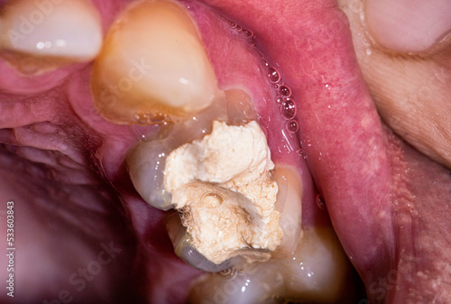 Tooth filling with temporary cement for root canal treatment. Tooth nerve removal, preparation for prosthetics, macro