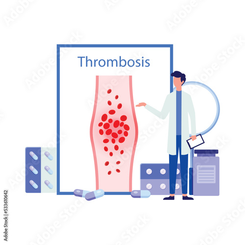 Medical Diagram of Deep Vein Thrombosis at leg area. Illustration about abnormally of blood floow.