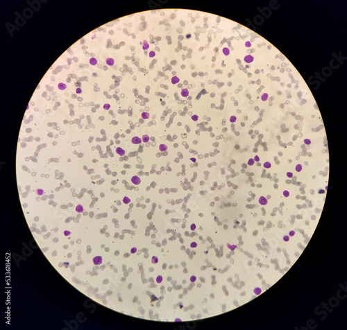 Microscopic image showing Chronic myeloid leukaemia (CML) is a type of cancer, all stage of granulocytic maturation is noted, CML in chronic phase. photo