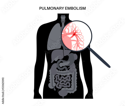 Pulmonary embolism disease