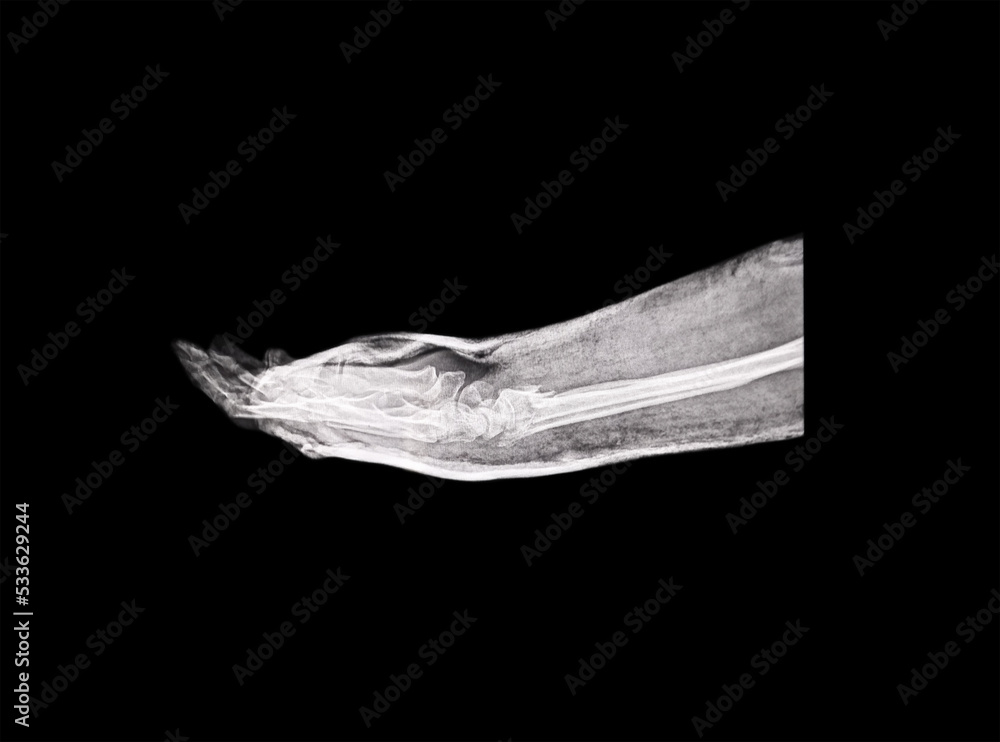 X-ray image of broken bone in human hand. Side view

