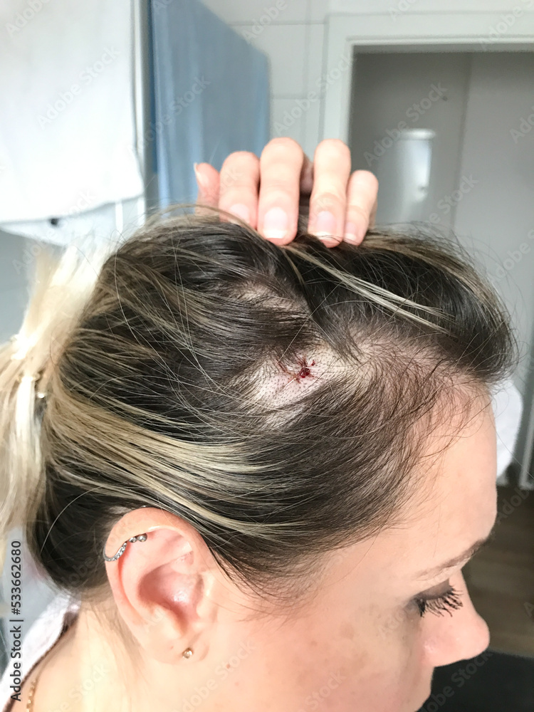 Fototapeta premium Head in a close-up with a fresh surgery scar