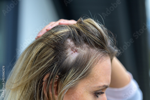 Head in a close-up with a fresh surgery scar