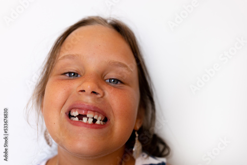 Fototapeta Adorable girl with open toothless mouth with temporary milk spacing crowding teeth in white isolated studio