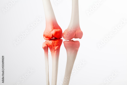 Knee meniscus inflamed, human leg, medically accurate representation of an arthritic knee joint