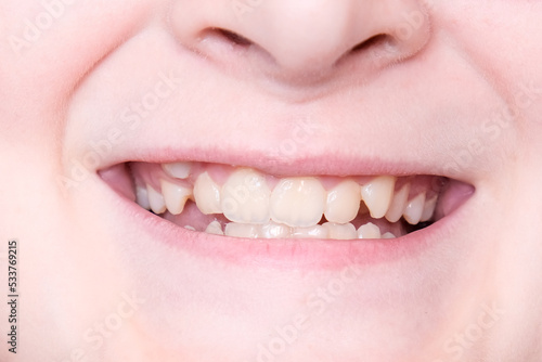 A 12 year old teeth with malocclusion close up, orthodontic problem and preparing for treatment, crooked teeth before installing braces