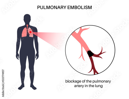 Pulmonary embolism disease