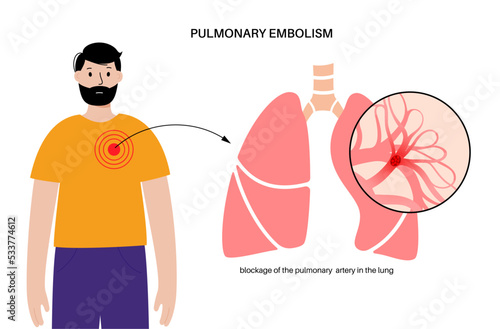 Pulmonary embolism disease