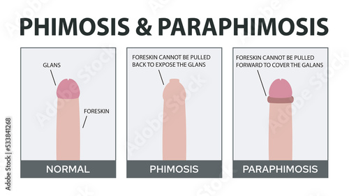 Phimosis and Paraphimosis Vector Illustration