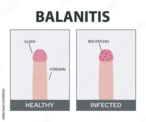 Balanitis Images – Browse 76 Stock Photos, Vectors, and Video | Adobe Stock