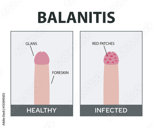 Candida Balanitis Vector Illustration. Male Yeast Infection.