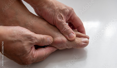 Tableau sur toile A person suffering from gout pain in the toe joint.