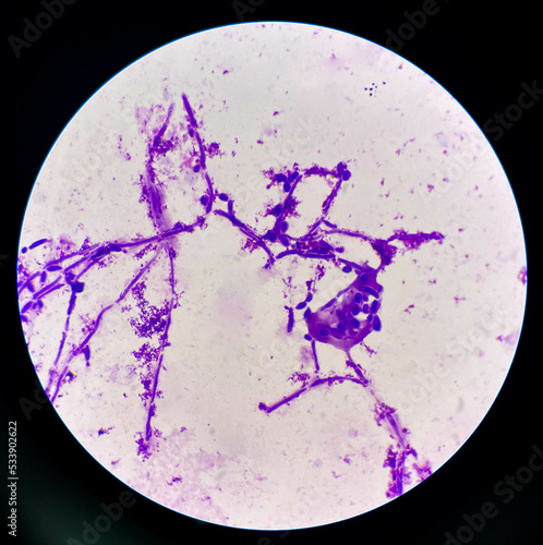 Obraz na płótnie Budding yeast cells with pseudohyphae in urine sample on wright gimsa stain.