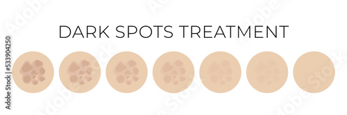 Dark Spots Treatment Isolated Illustration with Whitening or Fading Steps