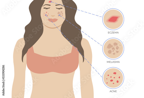 Skin Issues Eczema, Acne and Melasma. Skin Problems with Woman Illustration
