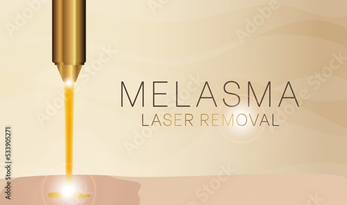Melasma Laser Removal Background Illustration