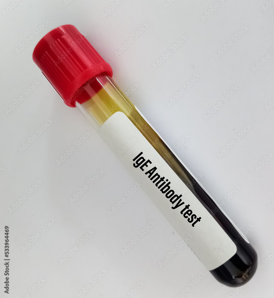 Blood sample for IgE antibody test. Allergy testing for detect allergen