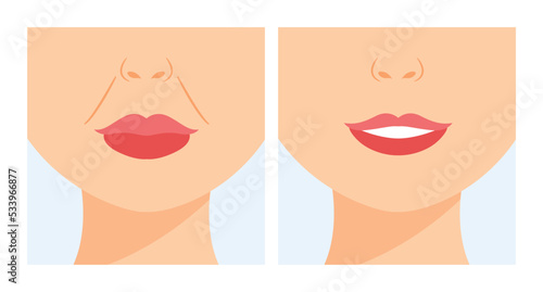 Nasolabial Folds on Face. Age Wrinkles. Skin Problems. Before and After. Beauty treatment of Nasolabial Folds with Fillers. Happy Smile. Color Cartoon style. White background. Vector illustration.