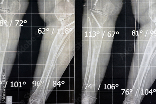 Plain x ray long film standing position showing both legs with bilateral metaphyseal genu varum, previous epiphysiodesis, left distal femur valgus and left medial tibial plateau depression
