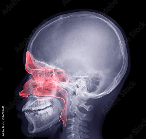Skull x-ray image fusion with paranasal sinuses 3D photo