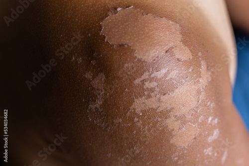 Male sunburned skin close up