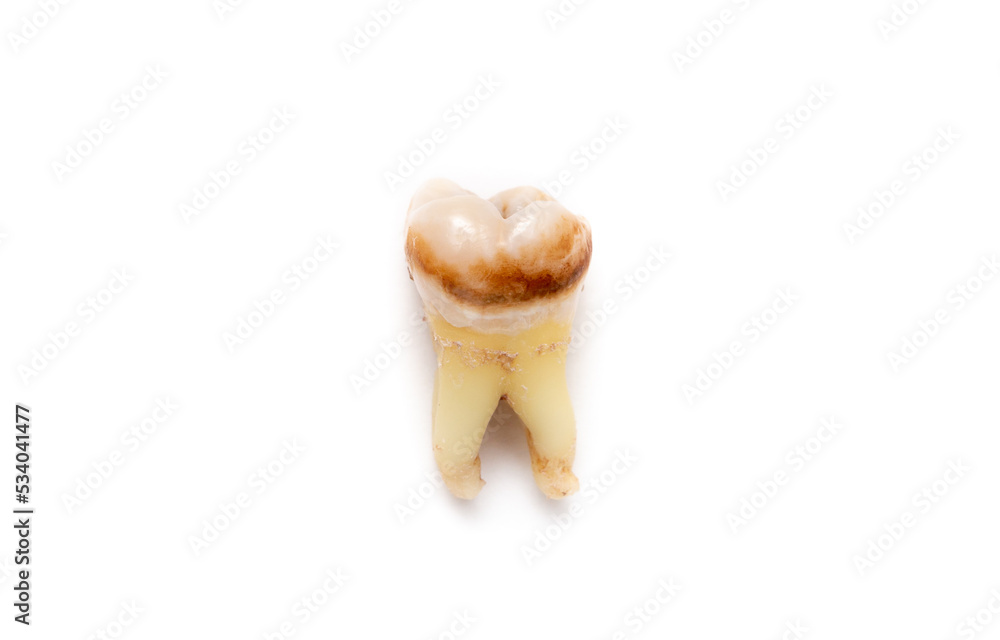 Fototapeta premium Close-up of a tooth with caries isolated on a white background. Removed wisdom teeth. Sick human teeth.