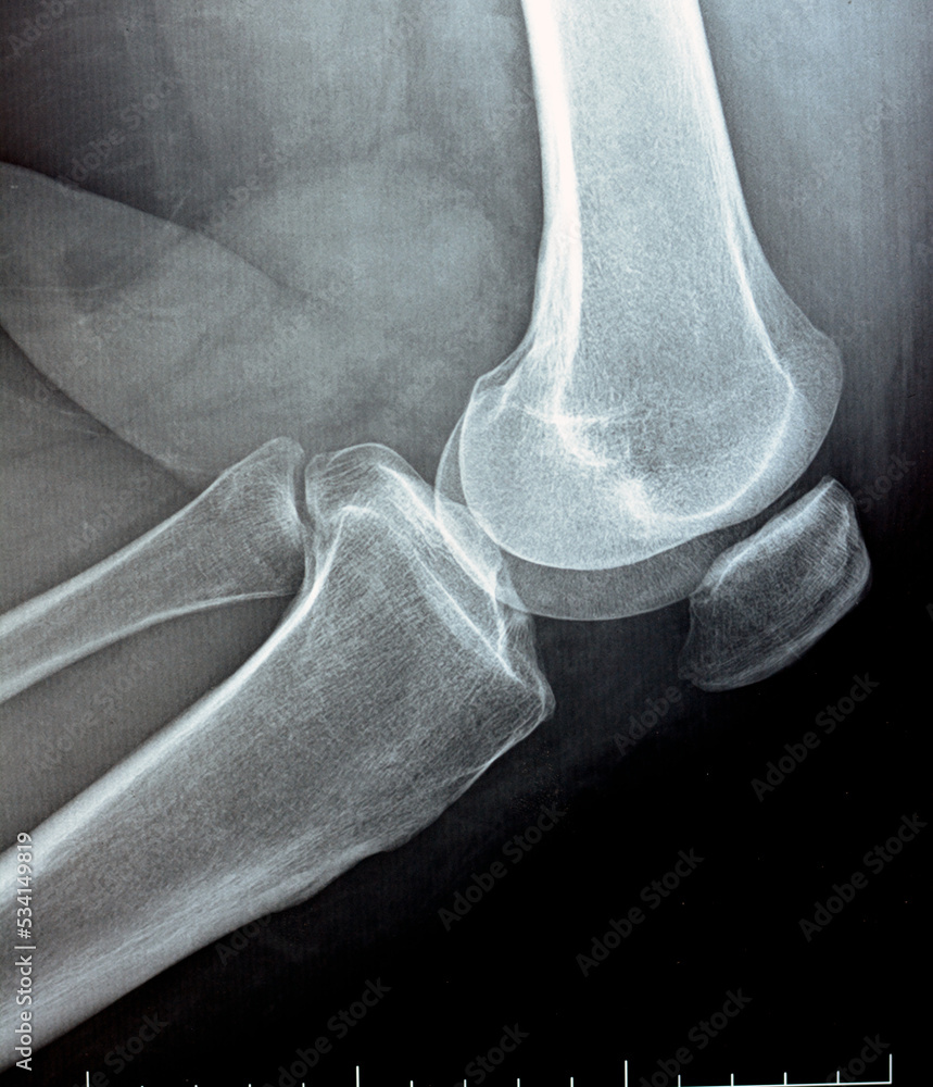 plain x ray on knee joint showing joint space narrowing and Subchondral