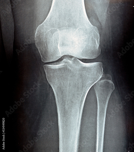 plain x ray on knee joint showing joint space narrowing and Subchondral Sclerosis on medial compartment (thickening of bone that happens in joints affected by osteoarthritis), knee osteoarthritis photo