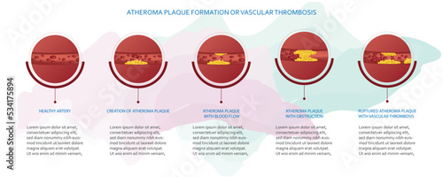 Infographics atheroma plaque formation, vascular thrombosis.
