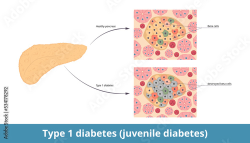 Type 1 diabetes (juvenile diabetes).	Diabetes mellitus type 1 originates when pancreatic beta cells are destroyed. Destructed β-cells in pancreas by the immune system and healthy pancreatic tissue. photo