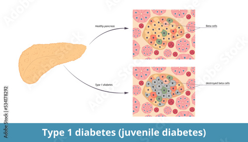 Type 1 diabetes (juvenile diabetes).	Diabetes mellitus type 1 originates when pancreatic beta cells are destroyed. Destructed β-cells in pancreas by the immune system and healthy pancreatic tissue.