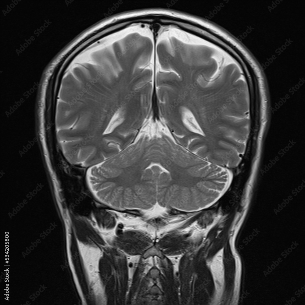 Normal Brain Mri Coronal
