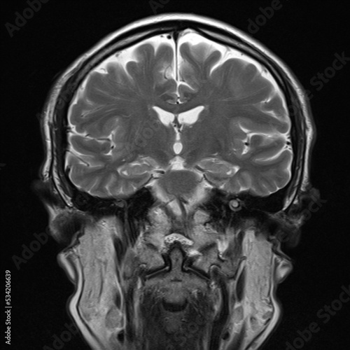 normal T1 coronal plane  brain Magnetic resonance imaging (MRI) photo