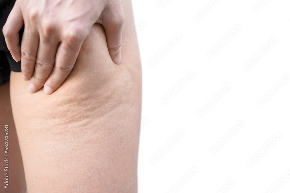 Close-up of Woman's hand holding and pushing legs with cellulitis fat. Orange peel skin. Healthy diet. Diet, exercise, reduce subcutaneous fat. Fat cellulite on women's legs