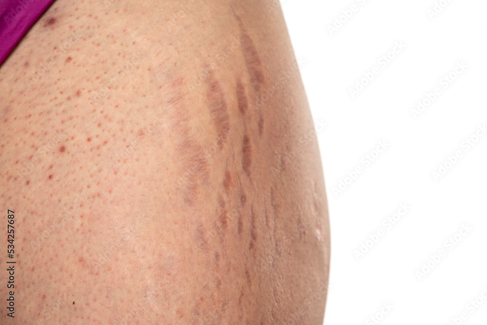 Female hip with stretch marks and groin with dots acne sensitive problematic skin Female hip with stretch marks and groin with dots acne sensitive problematic skin