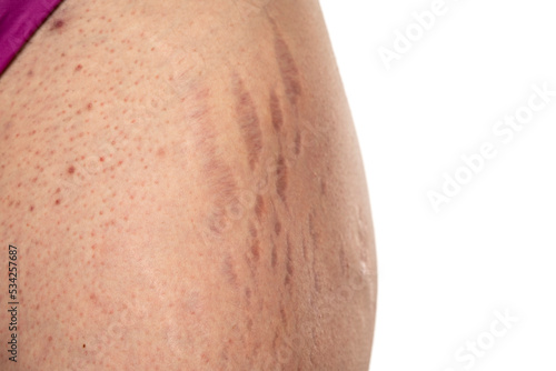 Female hip with stretch marks and groin with dots acne sensitive problematic skin