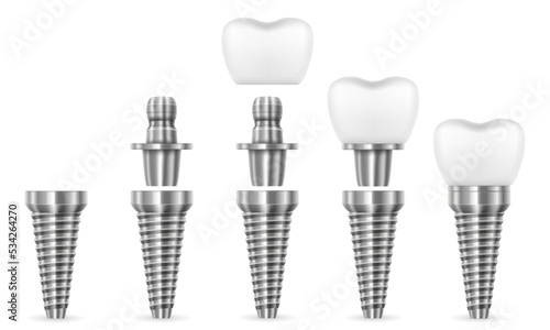 metal human tooth implant vector illustration